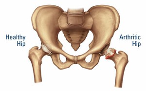 Hip Dysplasia Symptoms Causes Treatments Tests Recovery